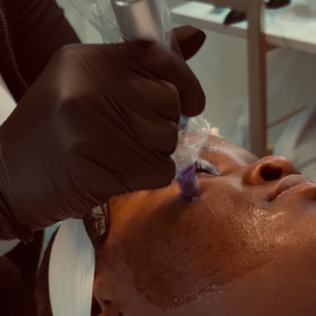 Microneedling - 3 months at Skin by Amile in Oxon Hill, MD