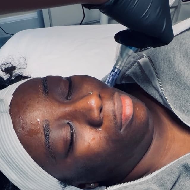 Microneedling- 6 months at Skin by Amile in Oxon Hill, MD